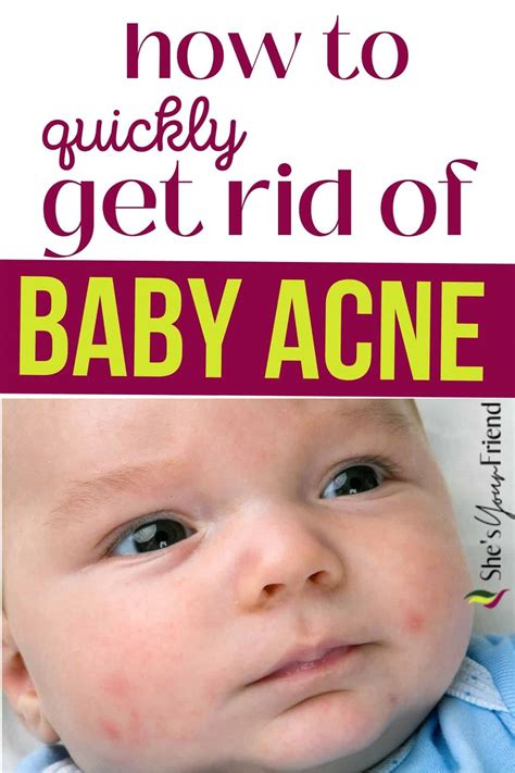 How To Get Rid Of Baby Acne