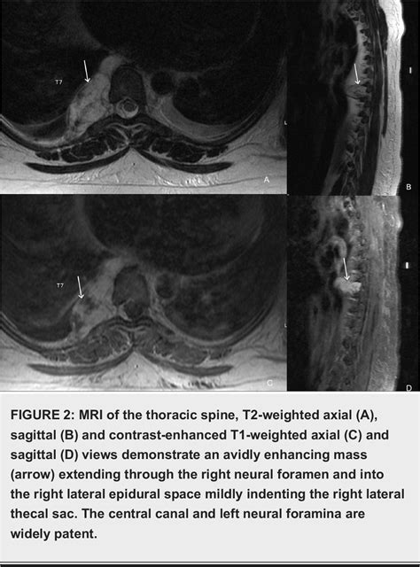 Figure From Spinal Epidural Capillary Hemangioma With Intrathoracic