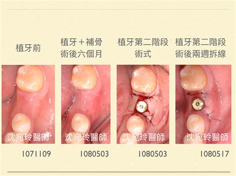 談植牙『第二階段術式』 佳誠美學牙醫診所