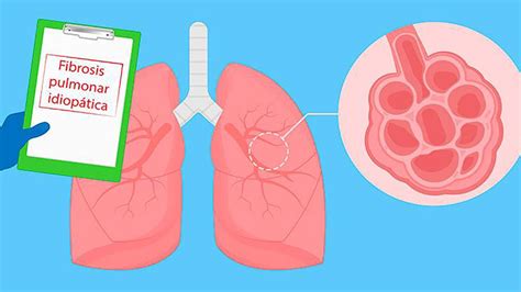 Fibrosis pulmonar idiopática: causas, síntomas y tratamiento