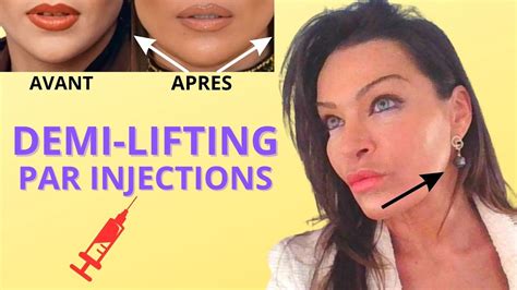 DEMI LIFTING PAR INJECTIONS Bas Du Visage Et Cou Sans Chirurgie Et Sans