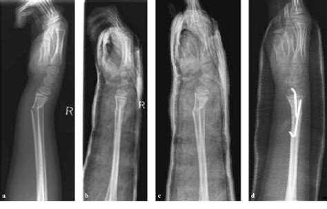 Distal Radius Fracture Types