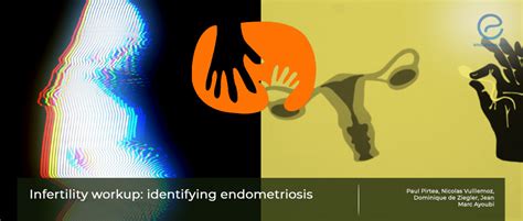 Endometriosis Associated Infertility How To Manage Endonews