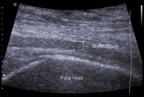 The Longitudinal Abdominal Sonogram Showing The Myometrial Lus