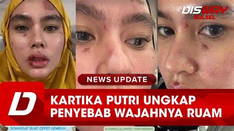 Kartika Putri Akhirnya Ungkap Penyebab Wajahnya Mengalami Ruam YouTube