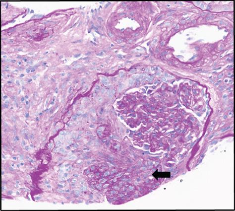 A Glomerulus Is Involved By Fibrocellular Crescent Black Arrow