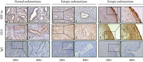 Differential Expression Of Gli1 And Hif 1α In Normal Eutopic And Download Scientific Diagram