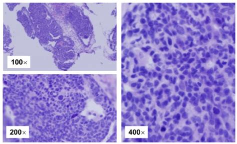 Histopathologic Examination Of A Primary Mammary Tumor In MNU Treated