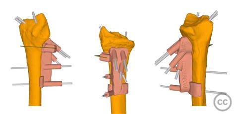 Corrective Osteotomy Using D Planning And Saw Guide