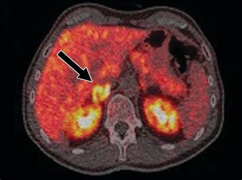 Sporadic Primary Pheochromocytoma A Prospective Intraindividual