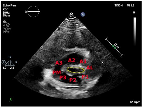 The Role Of D And D Echo In Mitral Stenosis