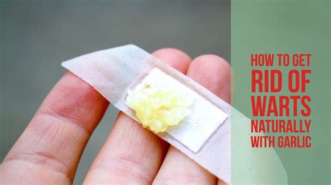 How To Get Rid Of Warts Naturally With Garlic Wellness Guide