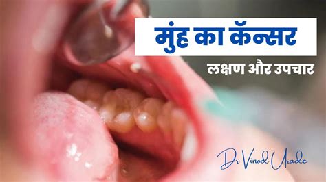 मुँह का कैंसर कैसे होता है Mouth Cancer Symptoms In Hindi Dr Vinod