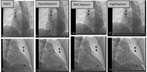 Fluoroscopic Images In The Left Anterior Oblique Top Row And Right