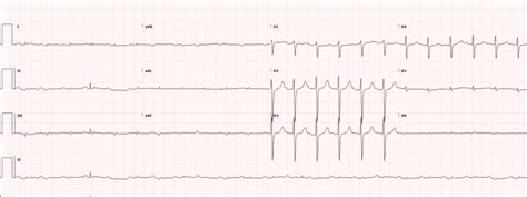 Low Voltage ECG - Differential Diagnosis of