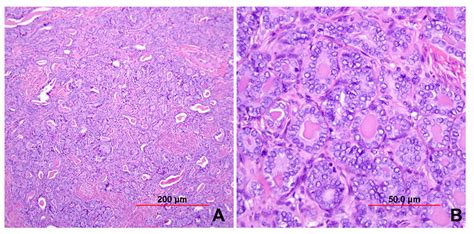 Pathology Of Cervical Carcinoma Glowm 17612 Hot Sex Picture