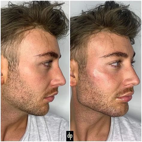 How Dermal Fillers Can Change The Jawline In Men Doctor Lanna