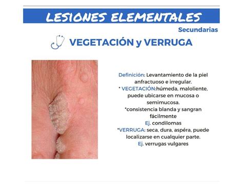 Vegetación y verruga uDocz