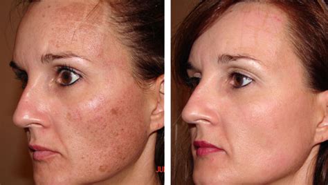 Laser Resurfacing Large Pores Before And After