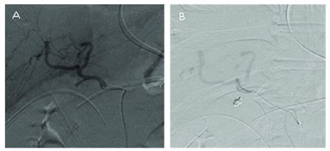 A Angiography Showing A Gda Stump Pseudoaneurysm But Ther Contrast Download Scientific