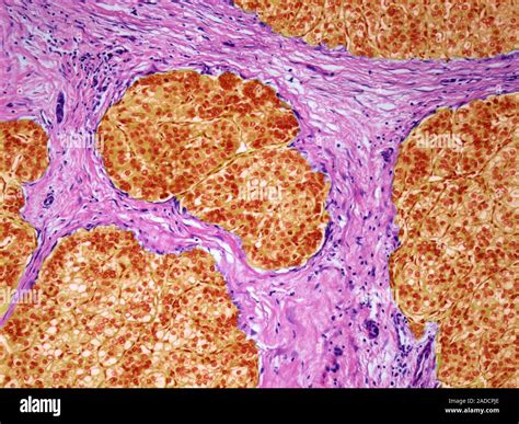 Le Carcinome H Patocellulaire La Lumi Re Microphotographie Lm D Une