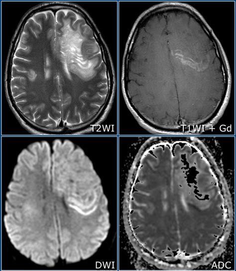 The Radiology Assistant : Multiple Sclerosis