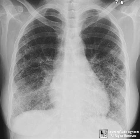 Learningradiology Scleroderma Lung Progressive Systemic Sclerosis