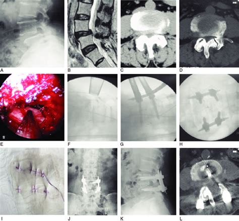 A 64 Year Old Woman With L4 5 Spinal Stenosis Combined With Download Scientific Diagram