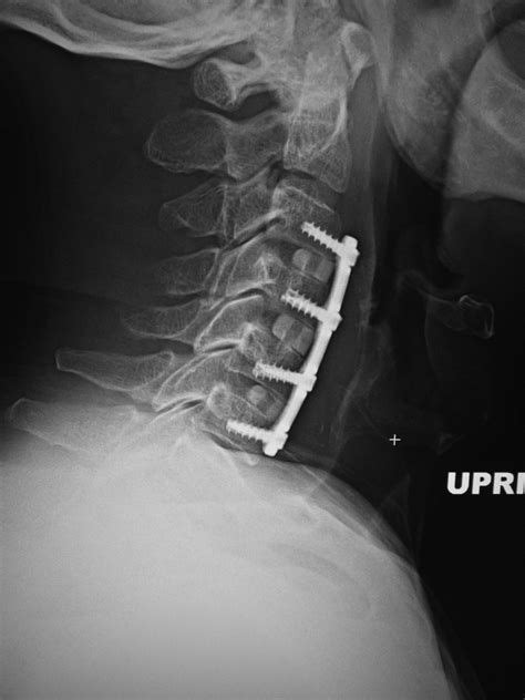 cervical spine fusion surgery - Yahoo Image Search Results | Cervical, Surgery, Fusion