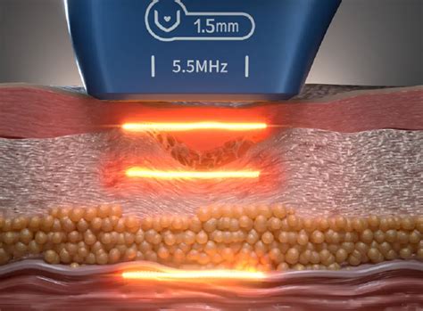 Transformative Results Hifu Machine Before And After Konmison What