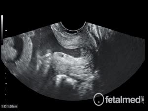 Tabela Comprimento Colo Uterino Fetalmed