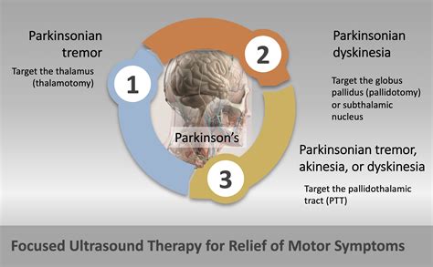 Brief Report Pallidothalamic Tractotomy By Focused Ultrasound For