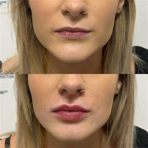 Lip Filler 1ml Lip Fillers Lip Fillers Juvederm Botox Lips