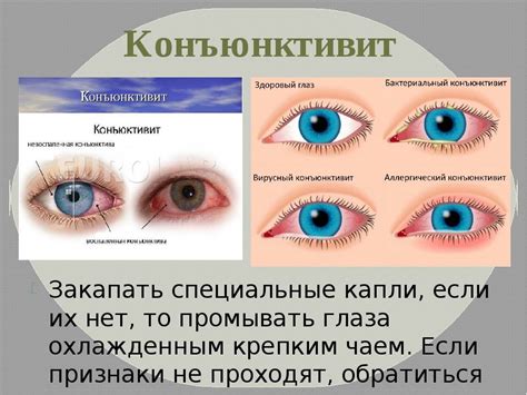 Терапия конъюнктивита