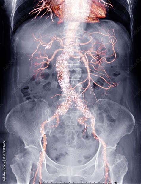 Stockfoto X Ray Abdomen With Mix Cta Whole Aorta Showing Abdominal