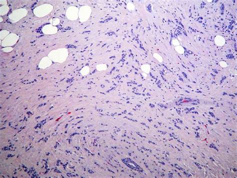 Capillary Hemangioma Lower Lip BosnianPathology