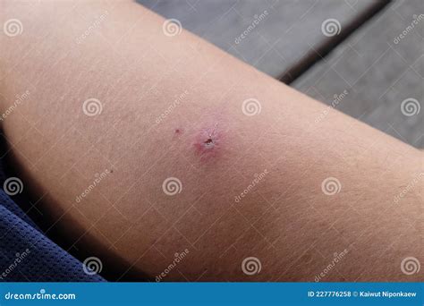 Purulent Wounds Caused By Allergies Stock Photo Image Of Blisters