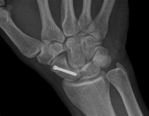 Trauma - Wrist- Carpal fractures and dislocations (eg scaphoid) - Dr Neil Kruger