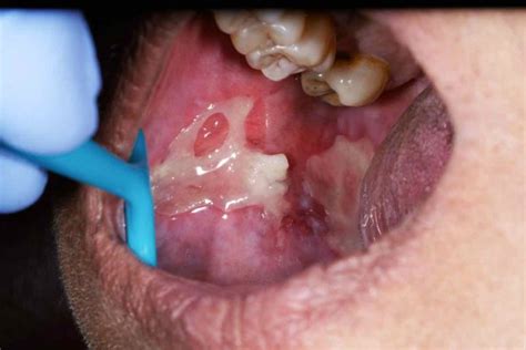 Mouth Ulcer Causes Symptoms Treatment And Cure Museum Dental Center