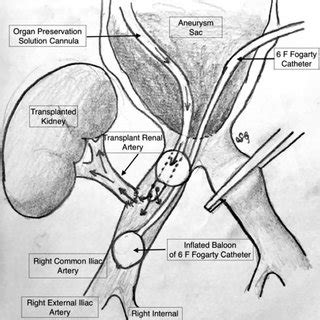 Illustration of surgical technique. | Download Scientific Diagram