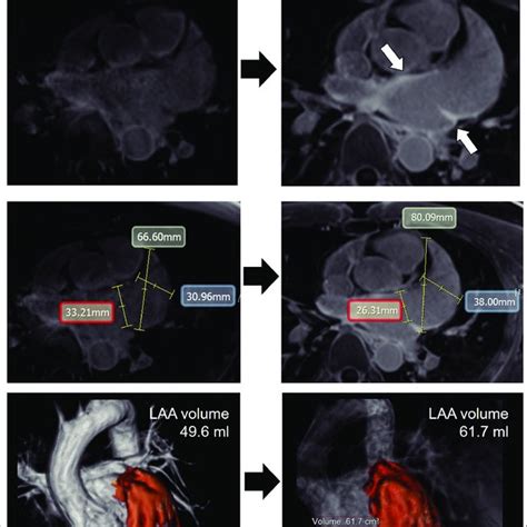 Ablation Induced La Scar By 3d Lge Cmr Imaging Post Procedural 3d