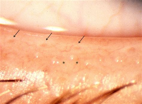 Meibomian Gland Diagram