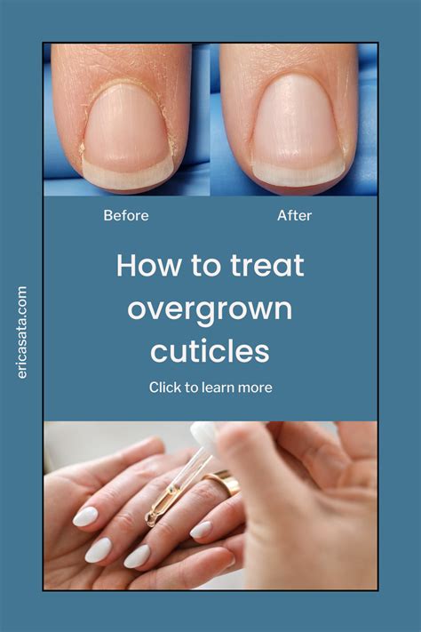 Cuticle Care Nail Cuticle Cuticle Remover Homemade Dry Cuticles How