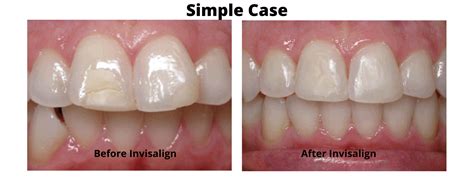 Can Invisalign Fix Overbite? Procedure, Benefits, and Cost