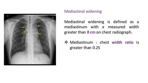 Mediastinum