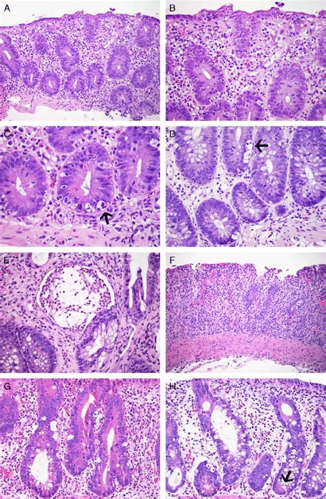 Colonic Biopsy Samples From Patients With Idelalisib Related Mucosal Download Scientific