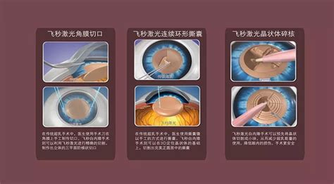 飞秒激光白内障焕晶手术，实现42岁阿姨“年轻”视力梦白内障新浪新闻