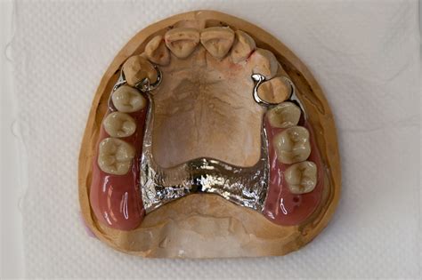 Dentures | Seven Hills Dentist | Capstone Dental