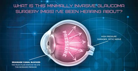 Have You Heard About Migs