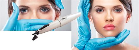 Cryopen Removal Of Skin Imperfections Beauty Therapy Brighton